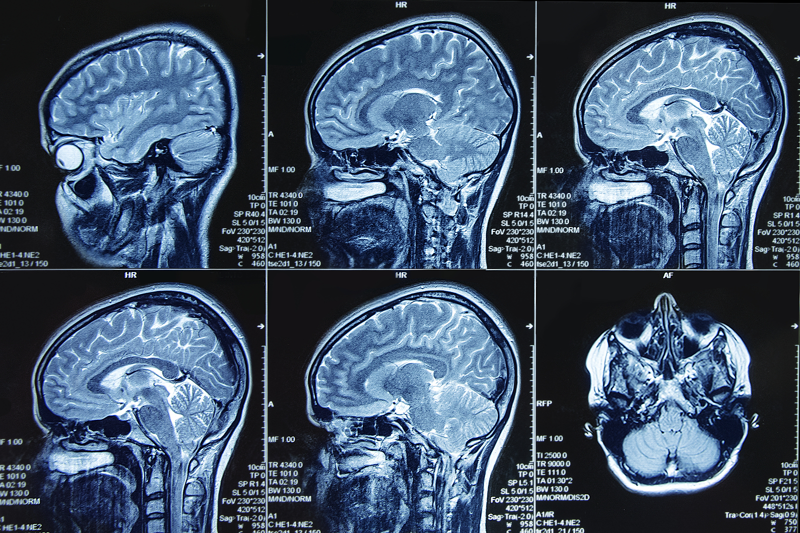 Photograph Of Magnetic Resonance Imaging Of Human Brain In Sagit